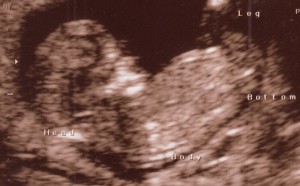 Pro-Life Ultrasound